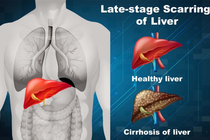 Liver Secondaries/Metastatic Liver Cancer