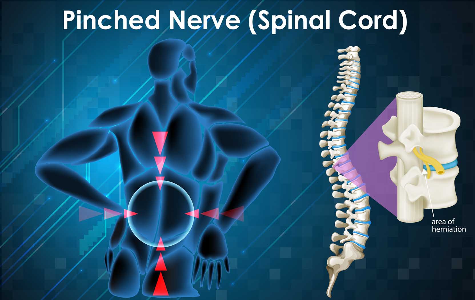 Spinal Cord Stimulator for Post-Surgery Pain Relief & Nerve Pain