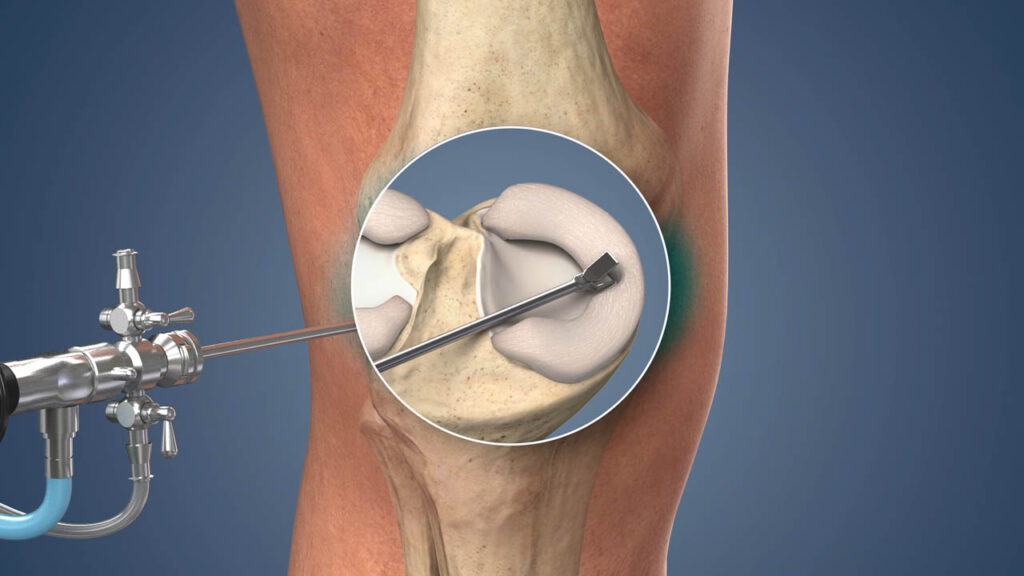 A meniscal tear may commonly occur from forceful twisting of the knee during sports or from repetitive movements in an ageing meniscus. Common symptoms include pain, stiffness and swelling.