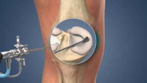 A meniscal tear may commonly occur from forceful twisting of the knee during sports or from repetitive movements in an ageing meniscus. Common symptoms include pain, stiffness and swelling.