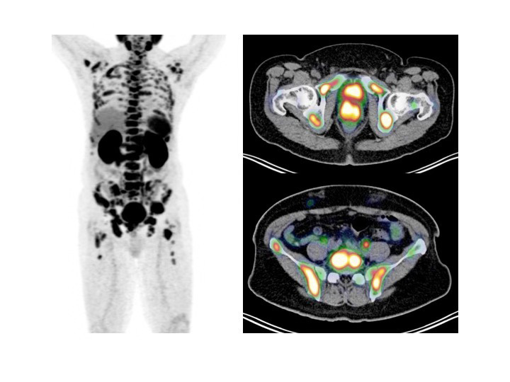 Prostate Specific Membrance Antigen (PSMA) Radionuclide Therapy for Prostate Cancer