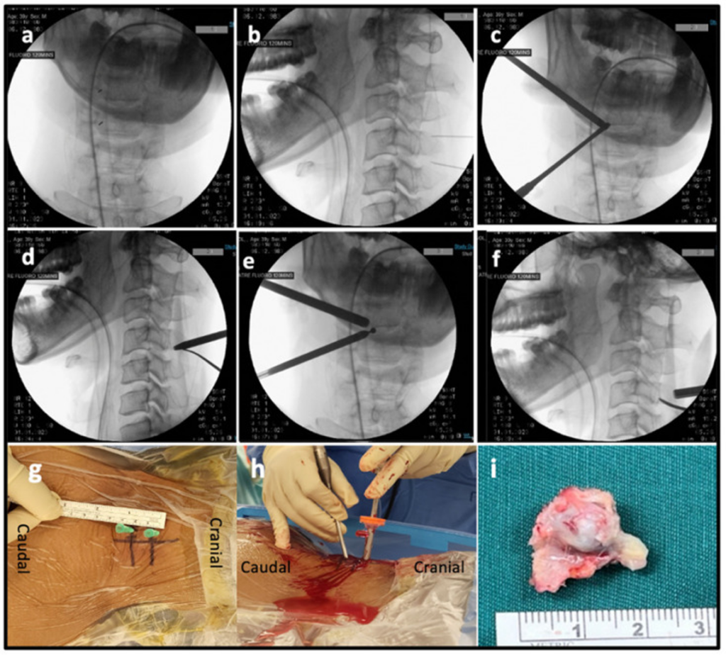 Figure 4: Biportal Cervical Endoscopic Decompression and resection of a benign osteochondroma. Figure 4 obtained from publication by Wu et al[25]