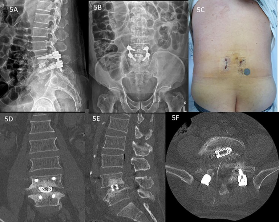 Figure 6: Post-operative Radiological Investigation and Picture showed the skin incision scars. Fig. 5A and B showed lateral and anteroposterior view of lumbar XR showed good positioning of the interbody cage and implants. Fig. 5C: showed 4 incisions required for 4 pedicle screws placement, the right upper incision was also used for endoscope working channel for Endo-TLIF. Fig. 5D: Coronal mid body CT scan showed good placement of bone graft and intebody cage. Fig. 5E: Midsagittal cut CT scan showing reduction of spondylolisthesis with good placement of cage and bone graft. Fig. 5F: Axial cut CT scan showing good oblique position of the cage. Figure reproduced from Kim and Wu et al[15]