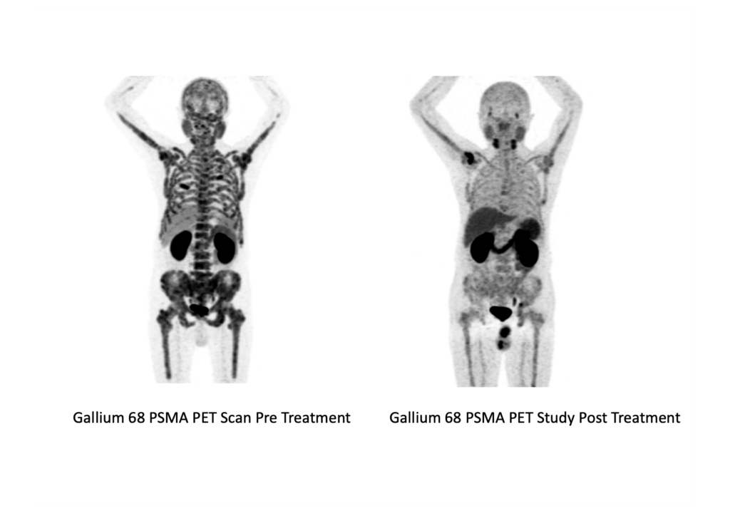 Prostate Specific Membrane Antigen (PSMA) Radionuclide Therapy