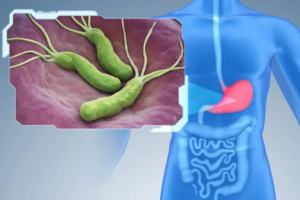 The Helicobacter pylori infection and Stomach Cancer Connection